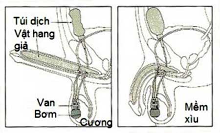 điều trị rối loạn cương dương bằng phẫu thuật cấy vật hang giả