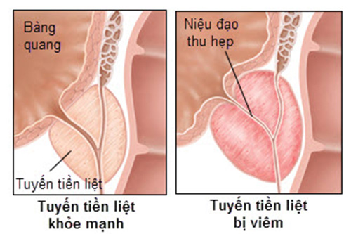 Dấu hiệu của bệnh viêm tiền liệt tuyến ở nam giới 