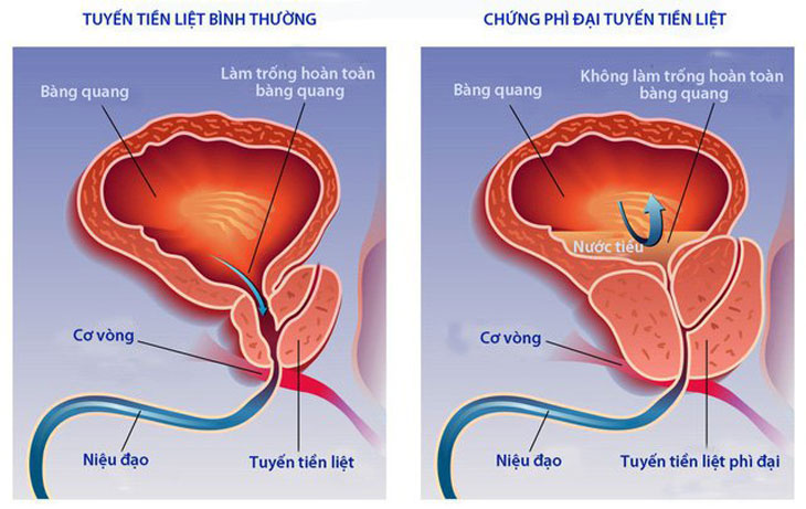 Tổng quan bệnh phì đại tiền liệt tuyến