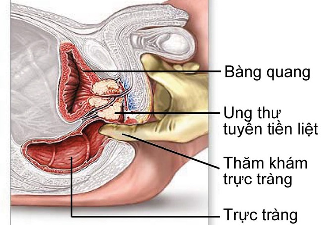 Dấu hiệu ung thư tiền liệt tuyến dễ nhầm với phì đại thông thường | Báo Dân  trí