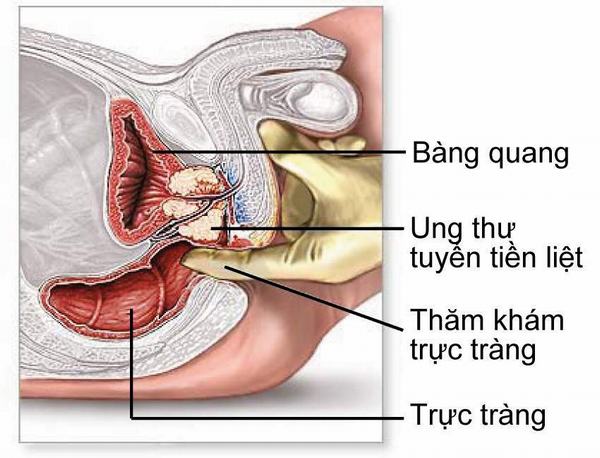 Khám phát hiện sớm ung thư tuyến tiền liệt | TCI Hospital